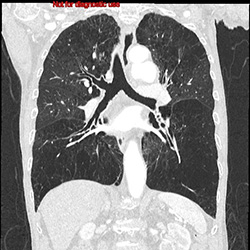 胸部　肺野の画像
